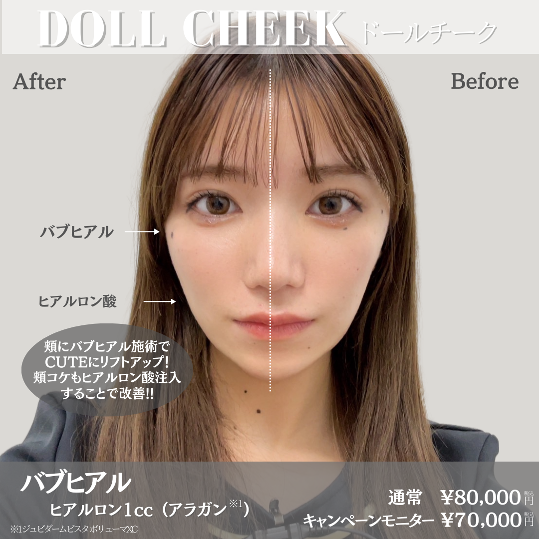 ヒアルロン酸 | BLINC CLINIC 