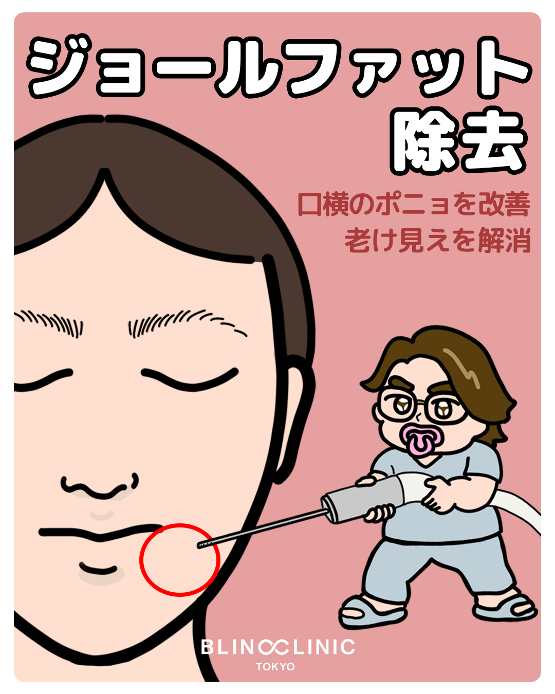 ジョールファット除去