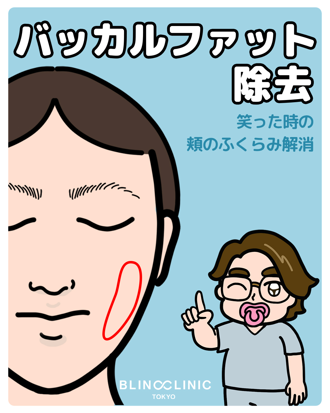 バッカルファット除去
