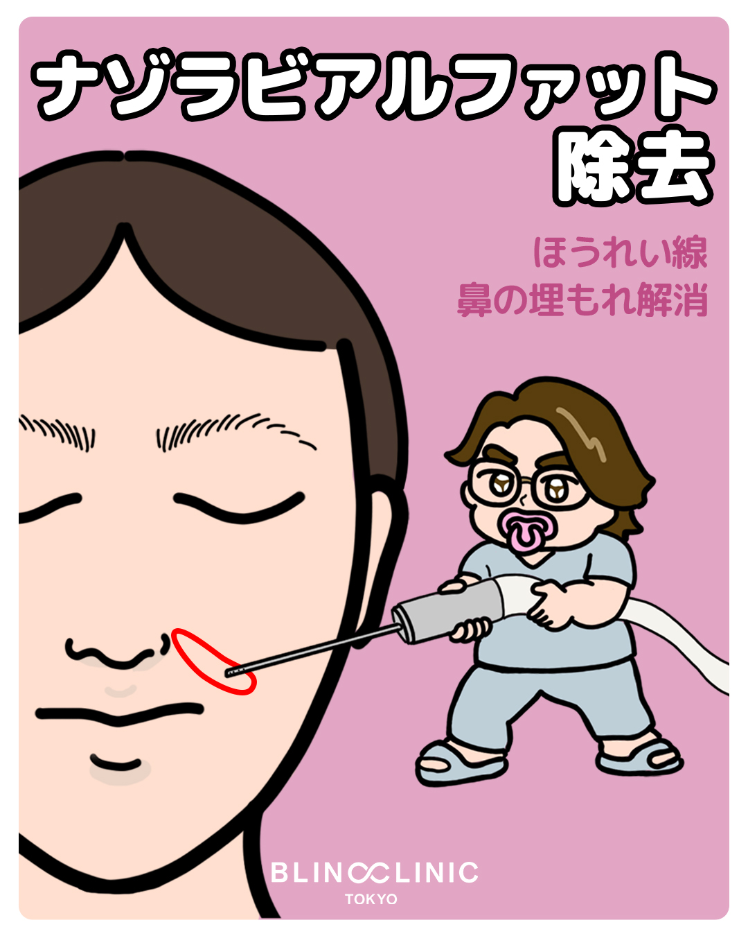 ナゾラビアルファット除去