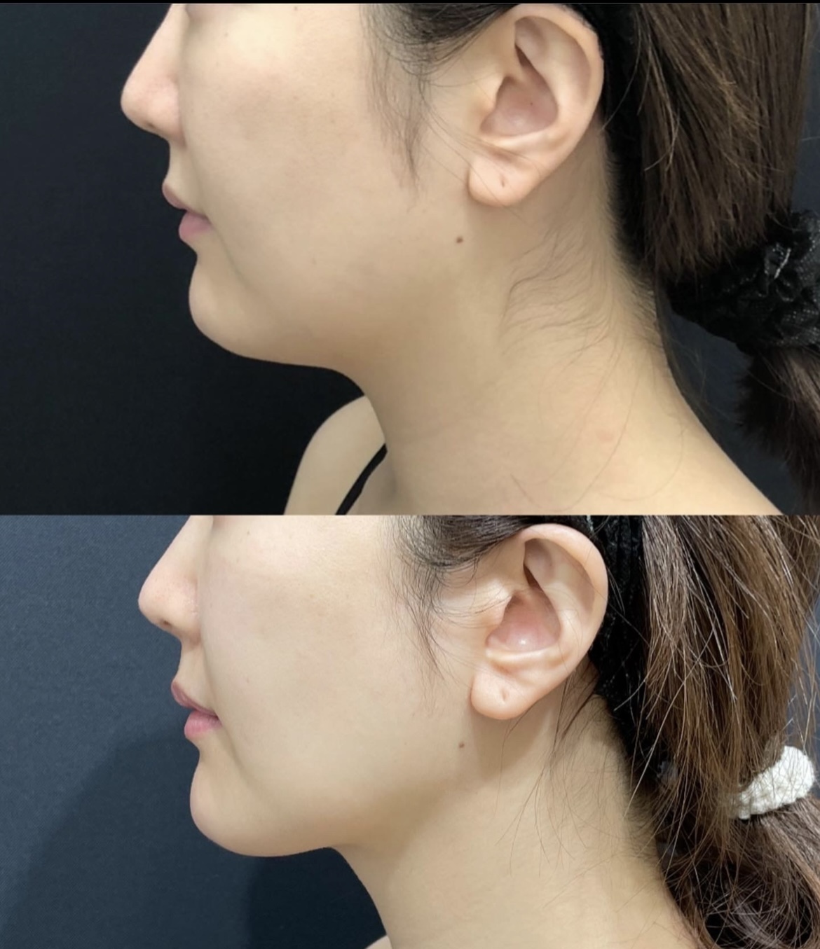 顔の脂肪吸引と糸リフトの症例