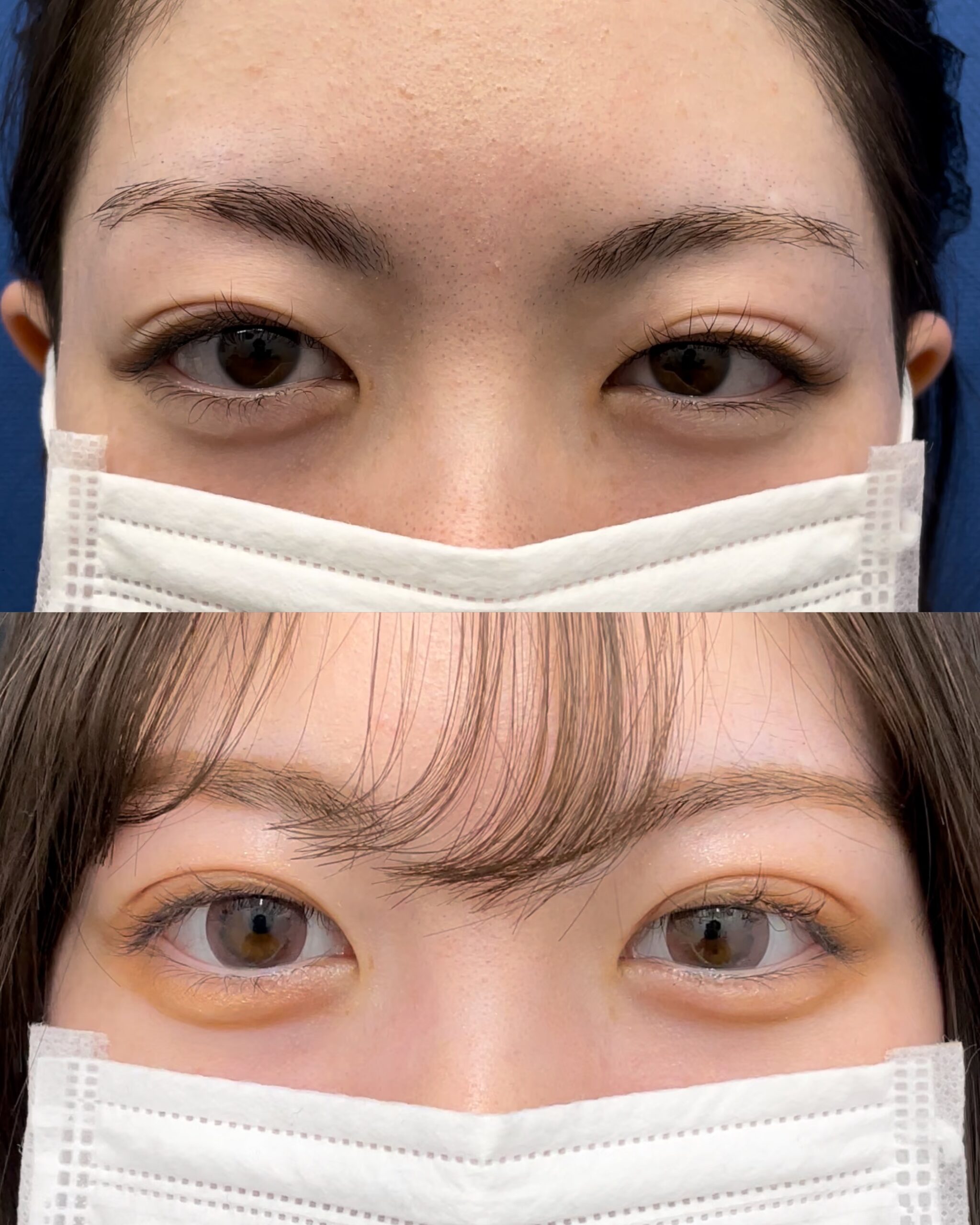 二重埋没の症例