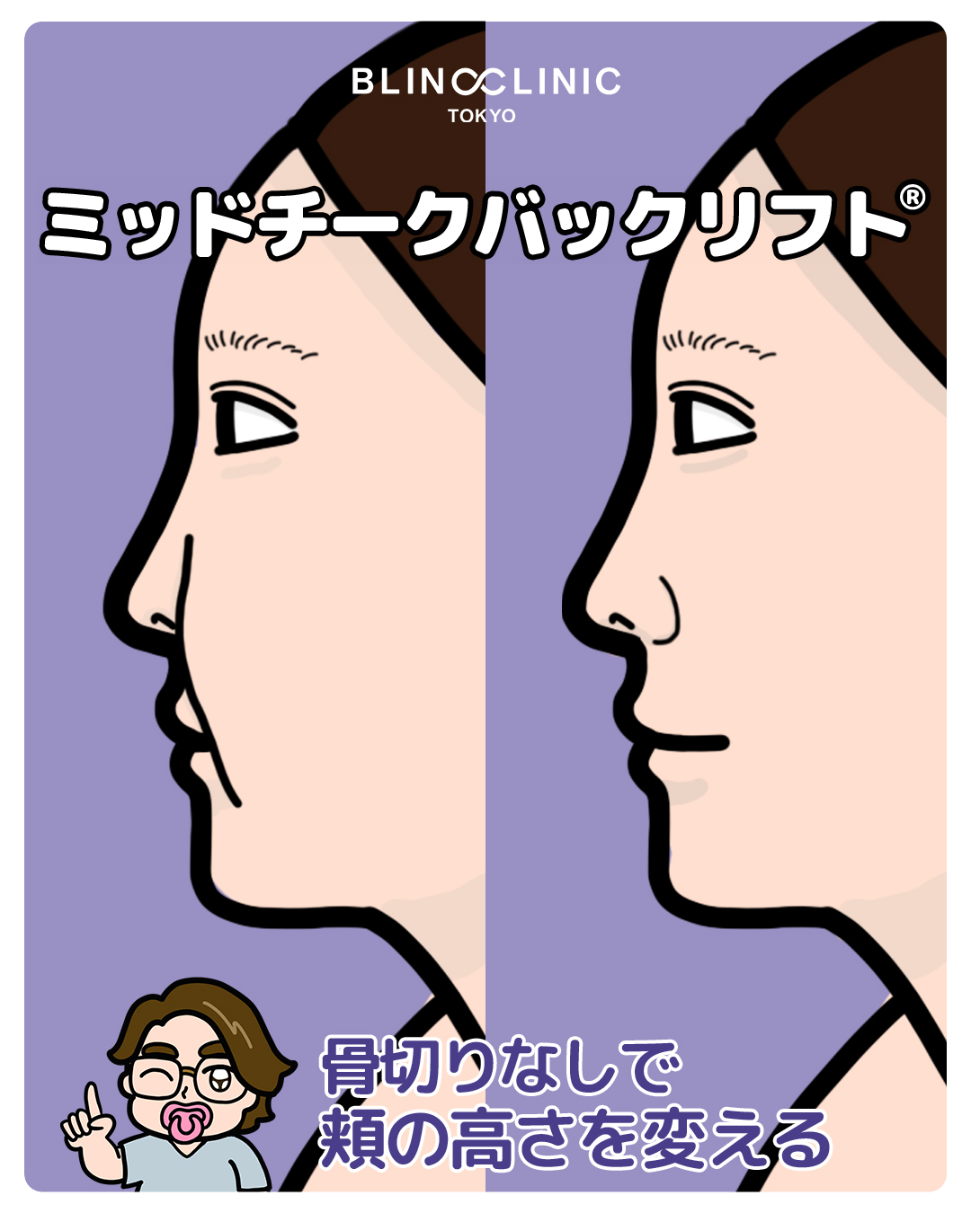ミッドチークバックリフト
