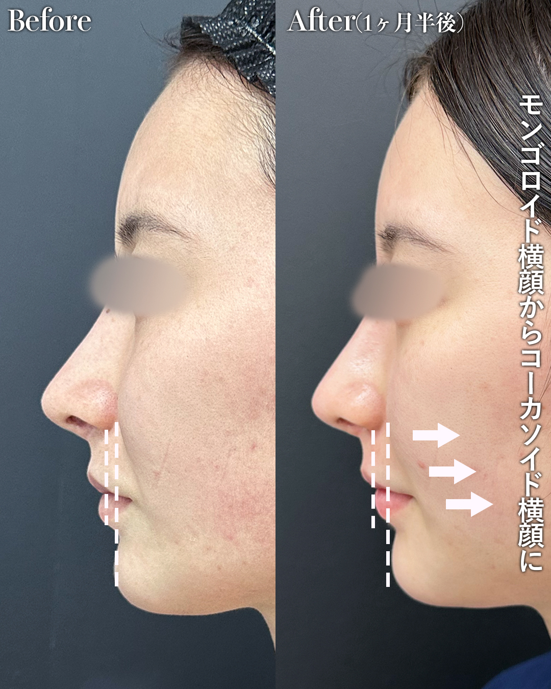 ミッドチークバックリフトの症例