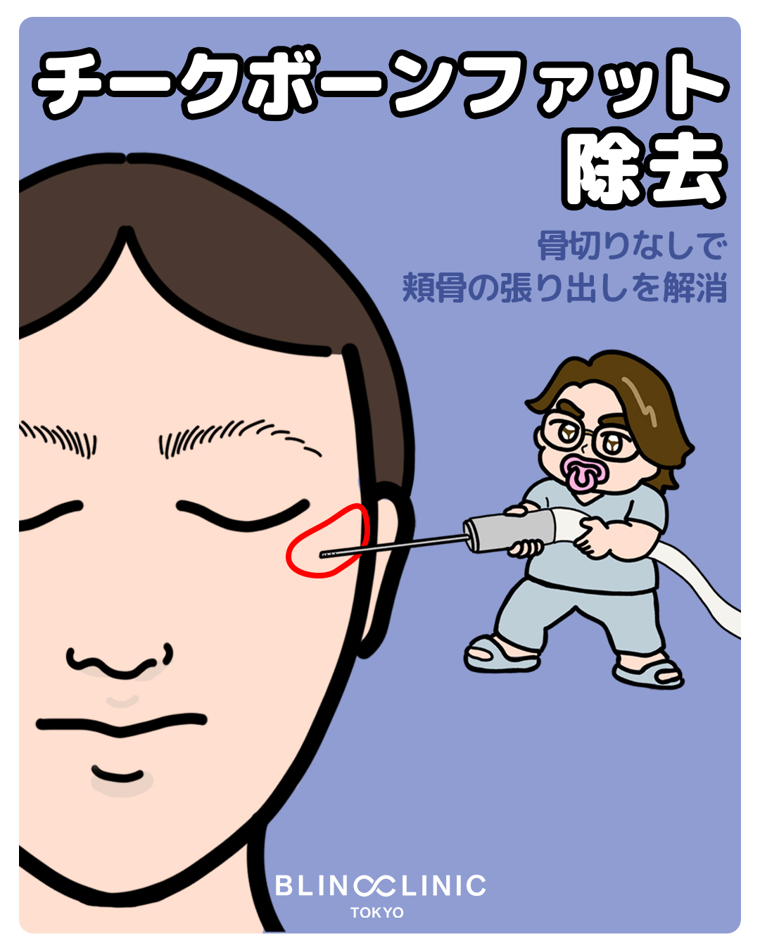 チークボーンファット除去