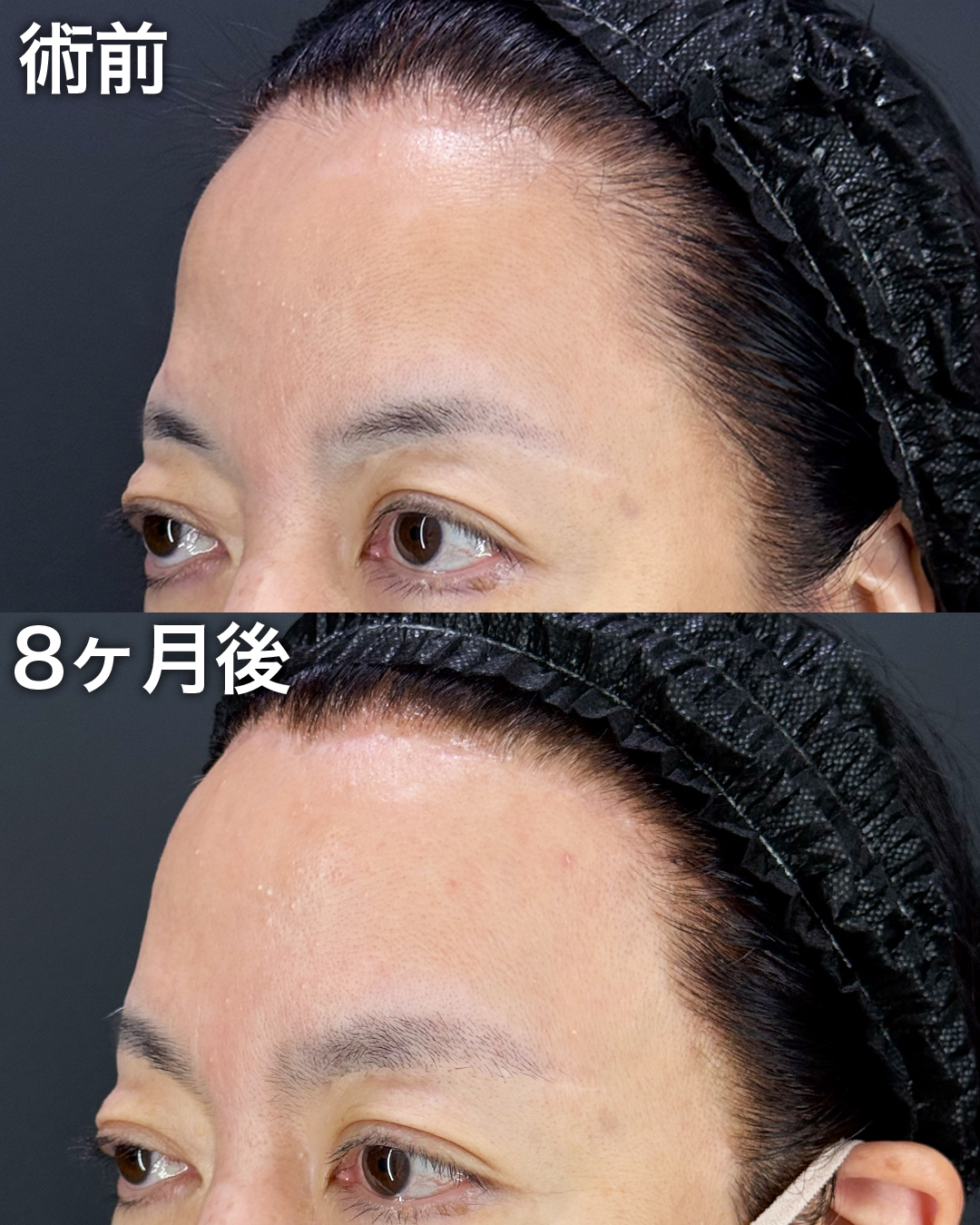 50代の方：前額リフト・こめかみリフト