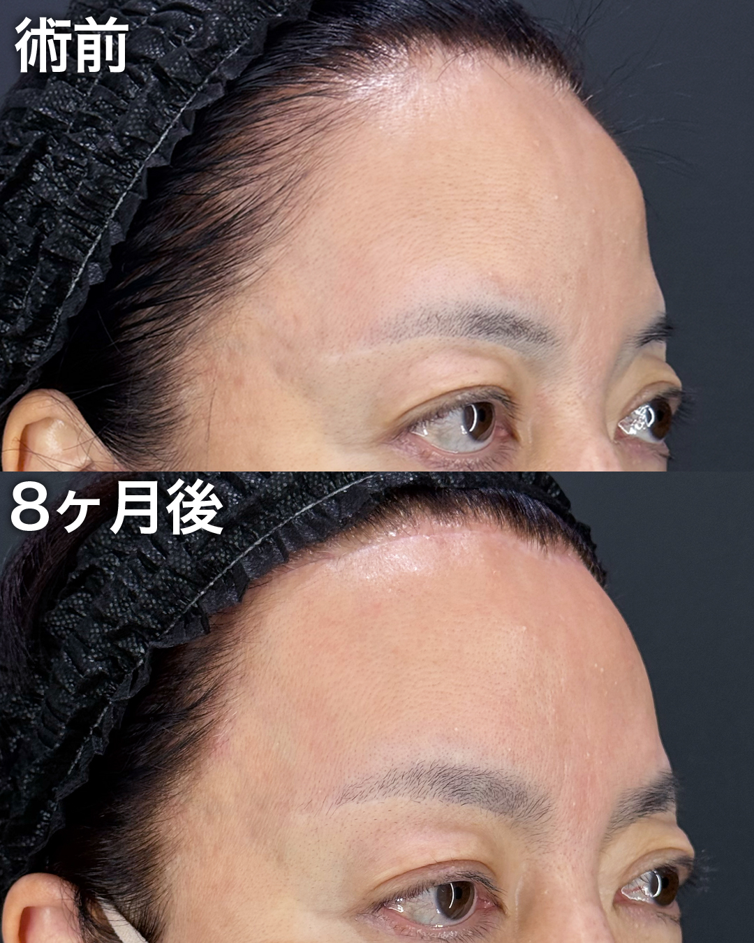 50代の方：前額リフト・こめかみリフト