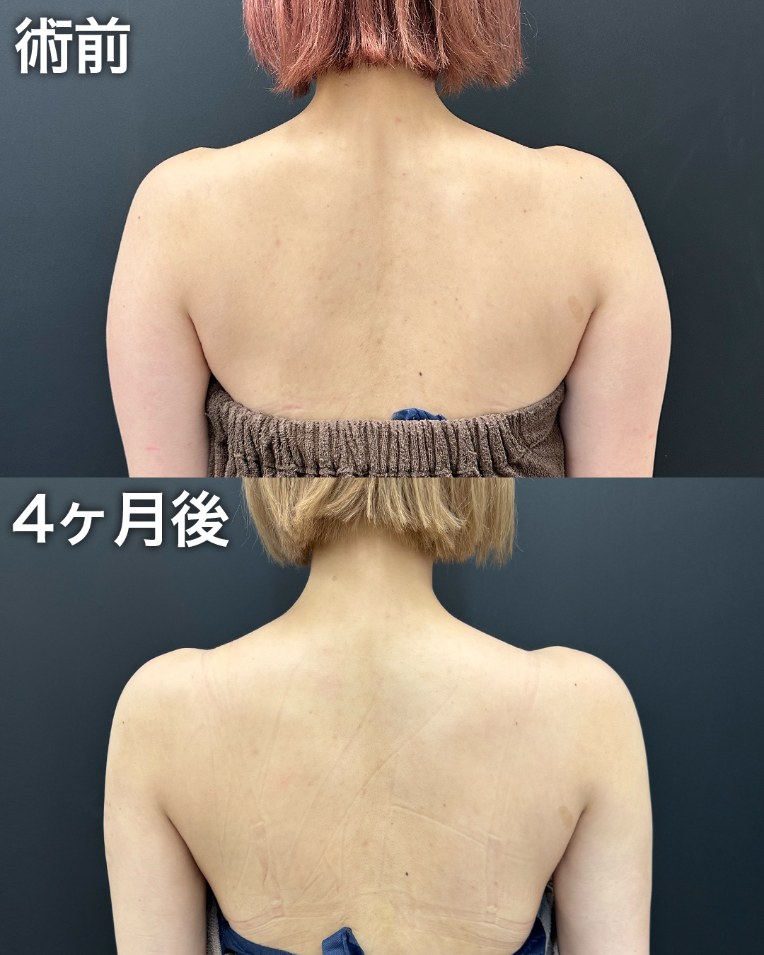 20代の方：脂肪吸引(二の腕・肩・肩甲骨横)