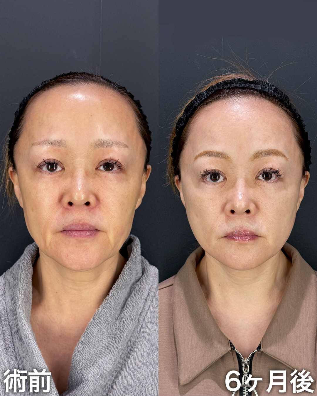 50代の方：切開リフト(Deep Plane Face Lift )・切開ネックリフト・バッカルファット吊り上げ