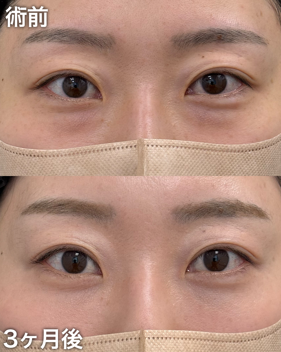 30代の方：裏ハムラ