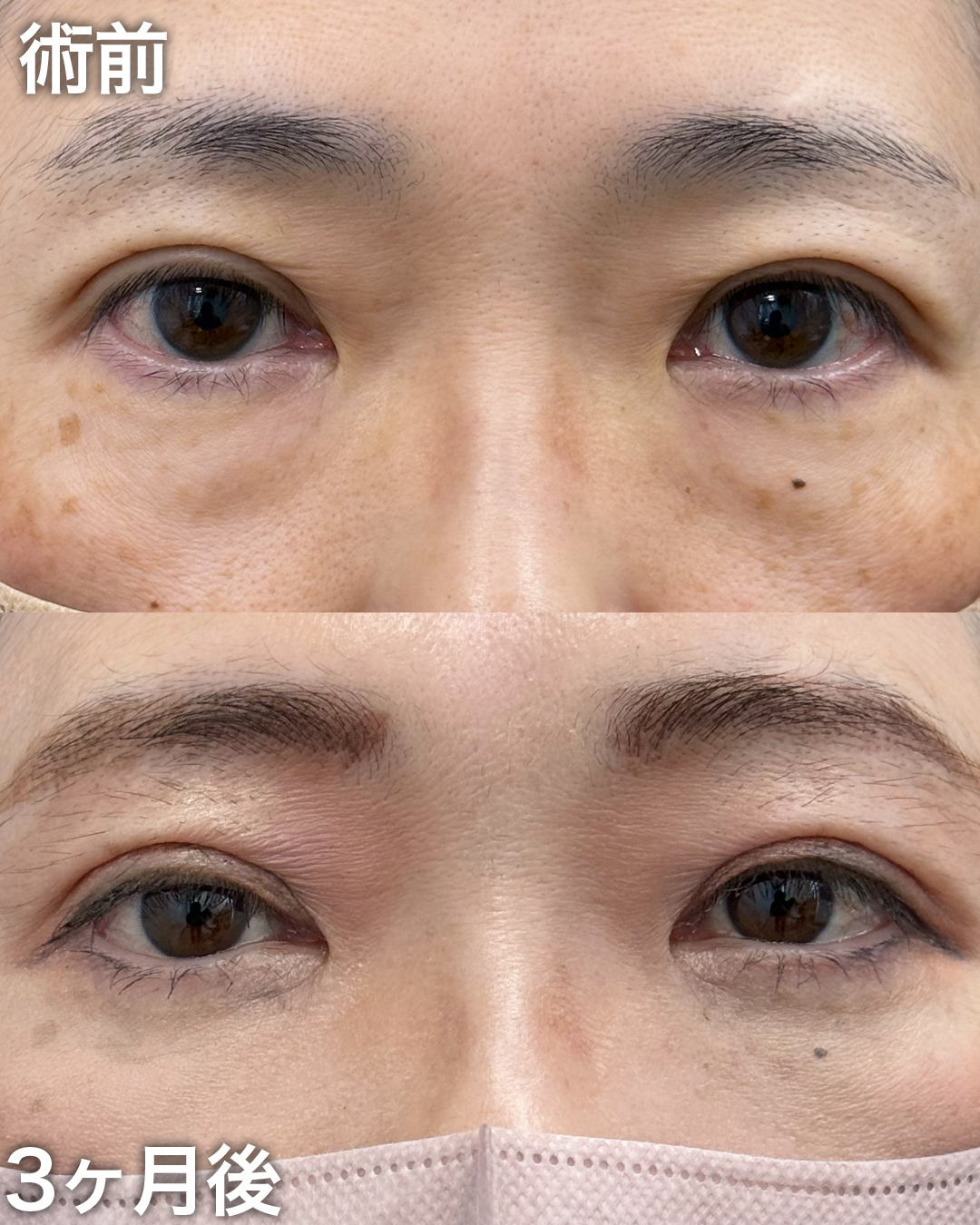 40代の方：裏ハムラ