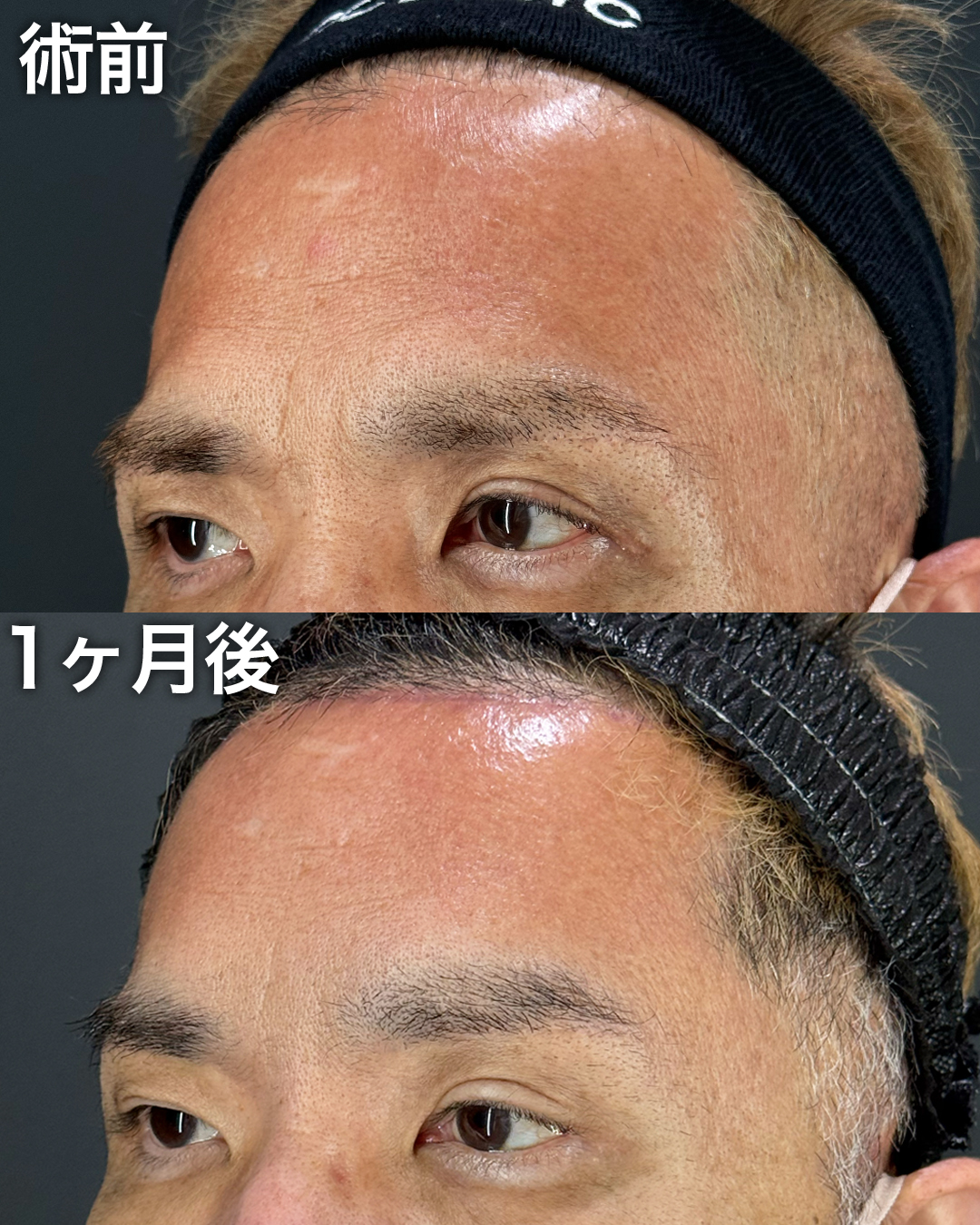 50代の方：前額リフト