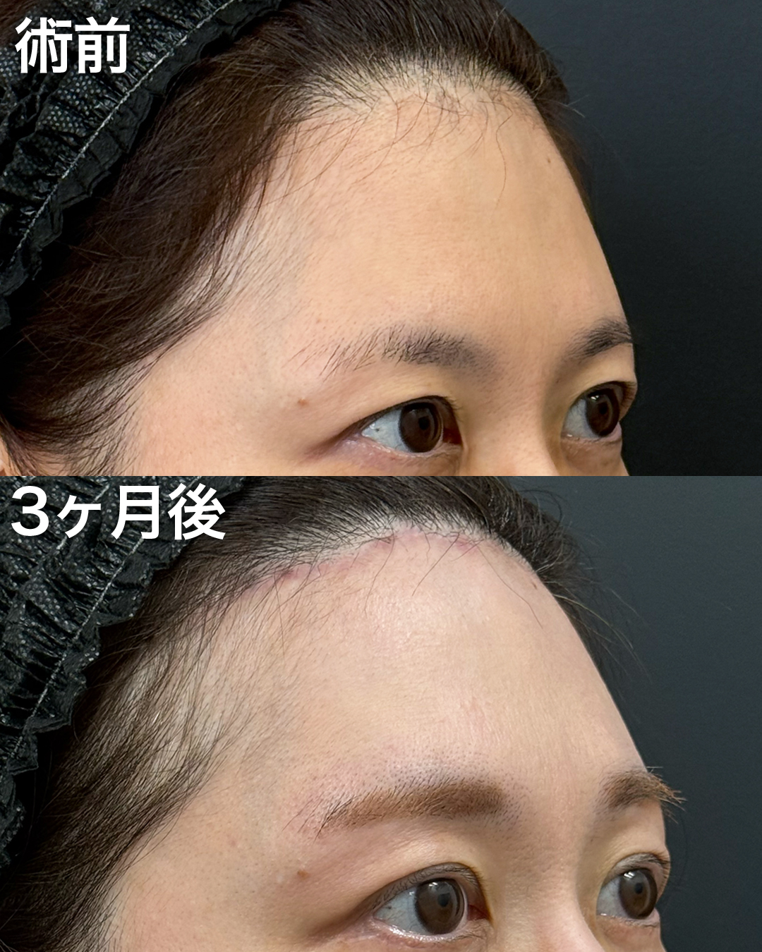 40代の方：前額リフト