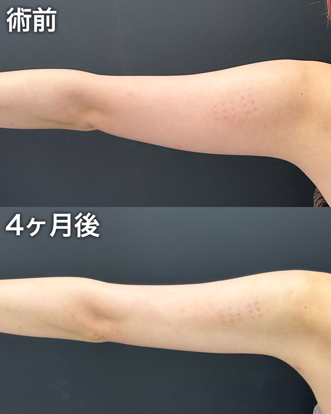 20代の方：脂肪吸引(二の腕・肩・肩甲骨横)