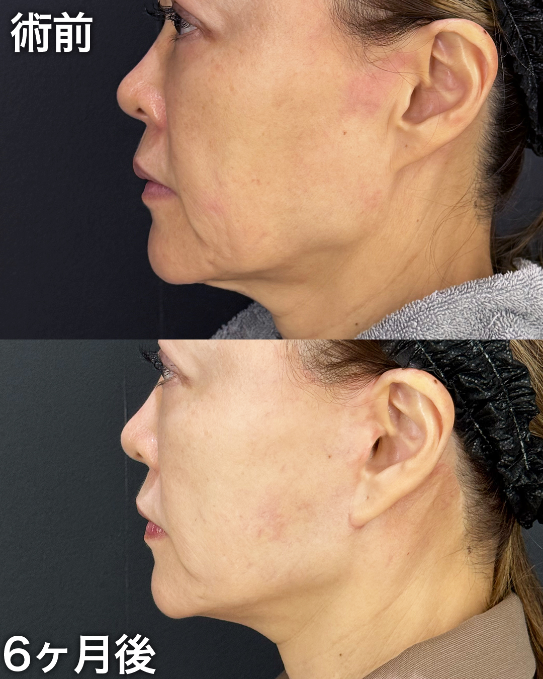 50代の方：切開リフト(Deep Plane Face Lift )・切開ネックリフト・バッカルファット吊り上げ