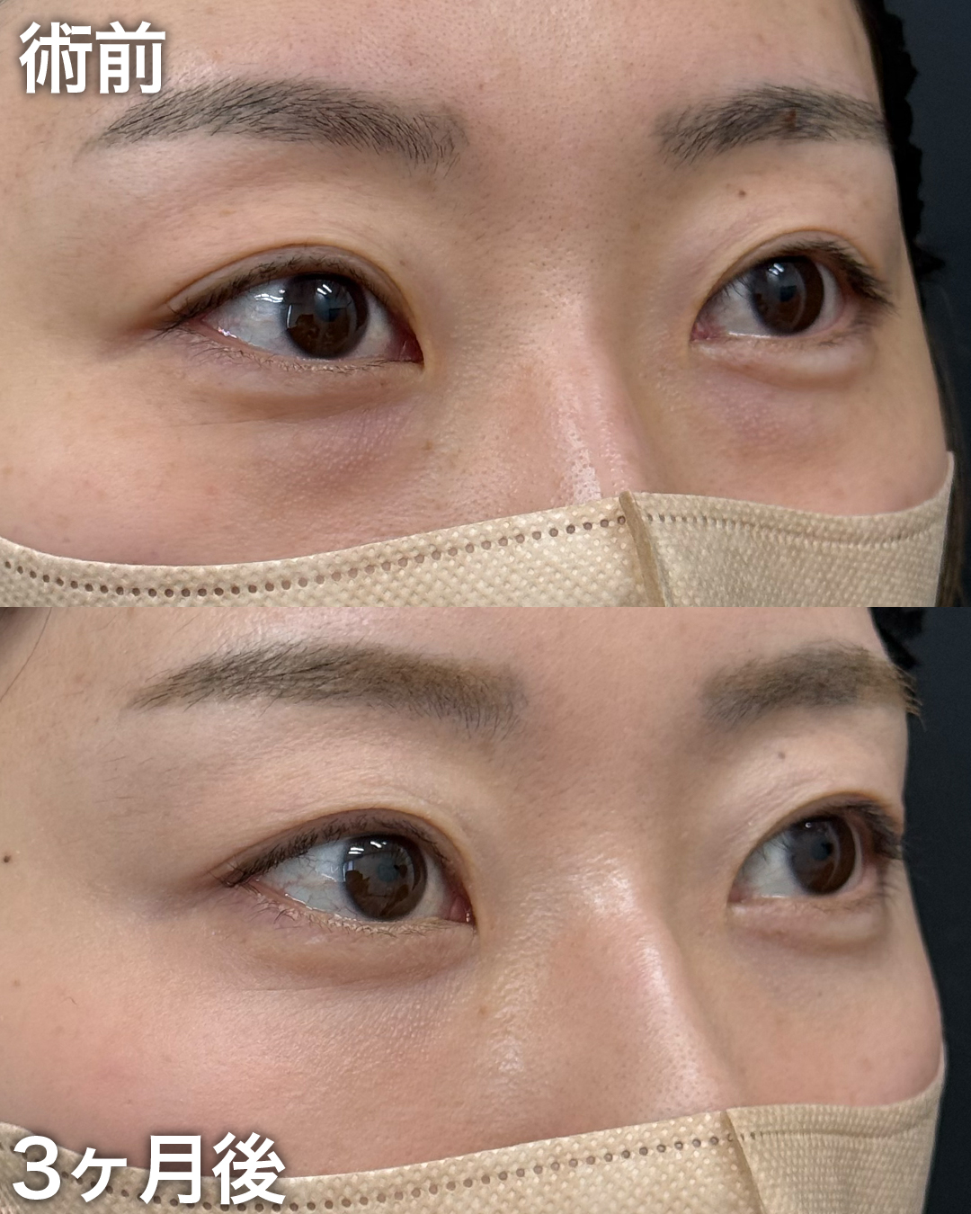 30代の方：裏ハムラ