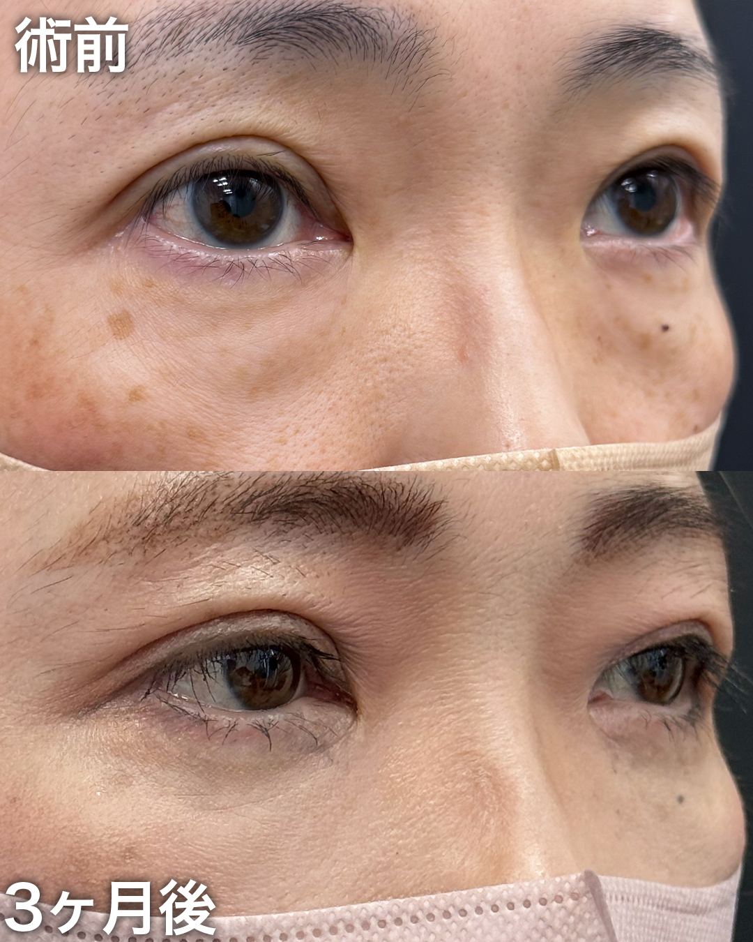 40代の方：裏ハムラ