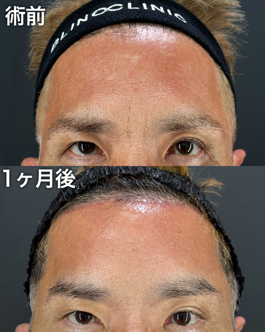 50代の方：前額リフト