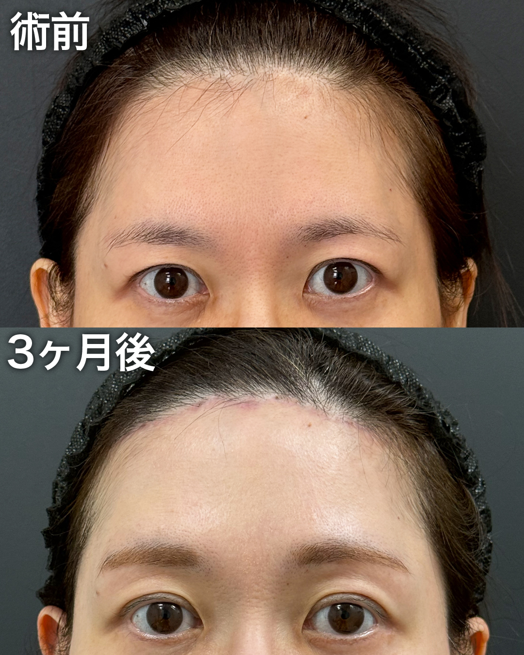 40代の方：前額リフト