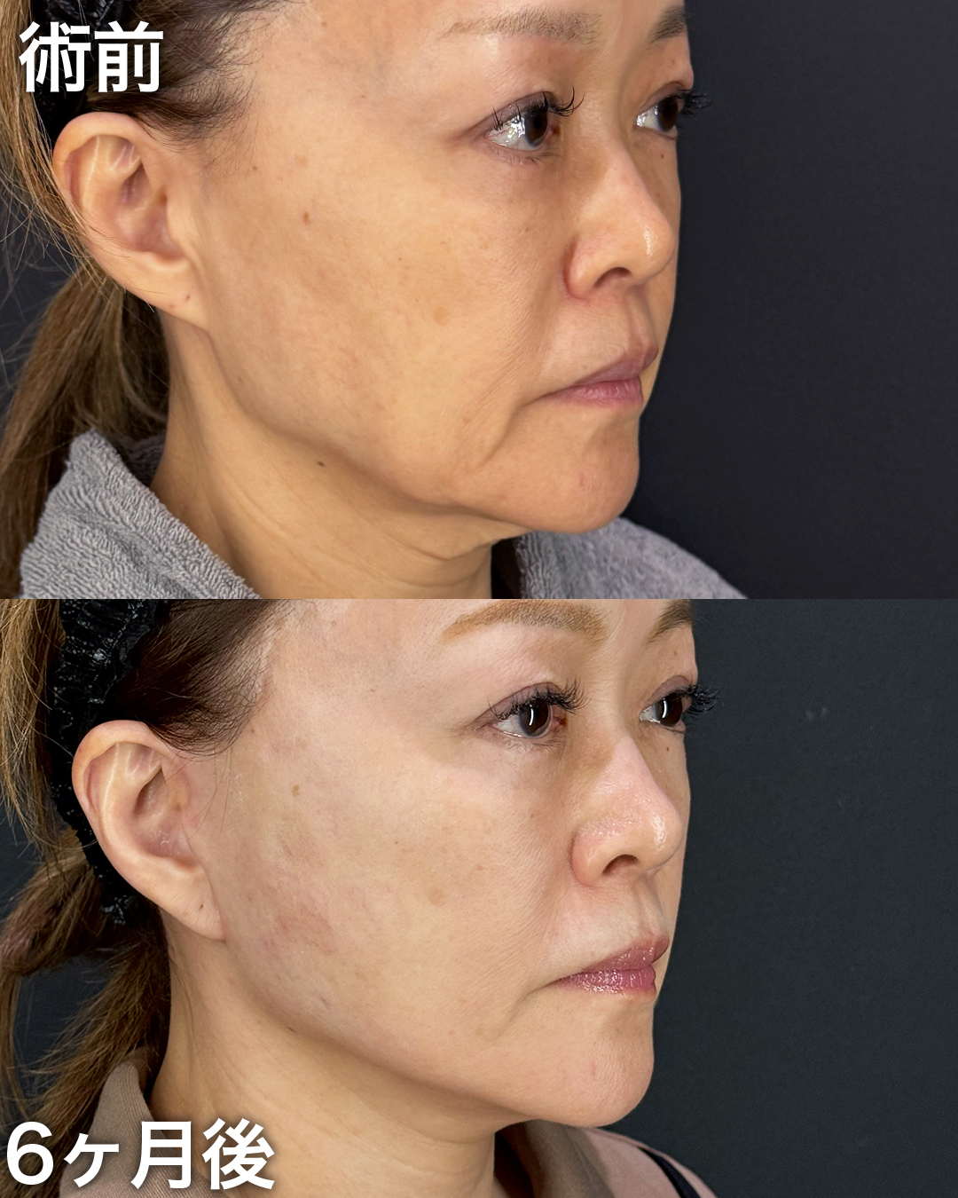 50代の方：切開リフト(Deep Plane Face Lift )・切開ネックリフト・バッカルファット吊り上げ