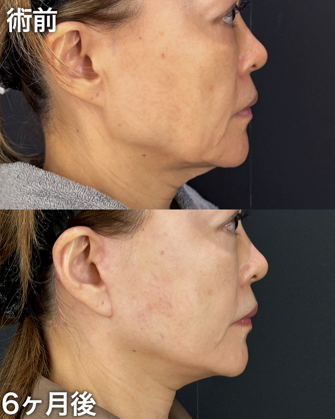 50代の方：切開リフト(Deep Plane Face Lift )・切開ネックリフト・バッカルファット吊り上げ