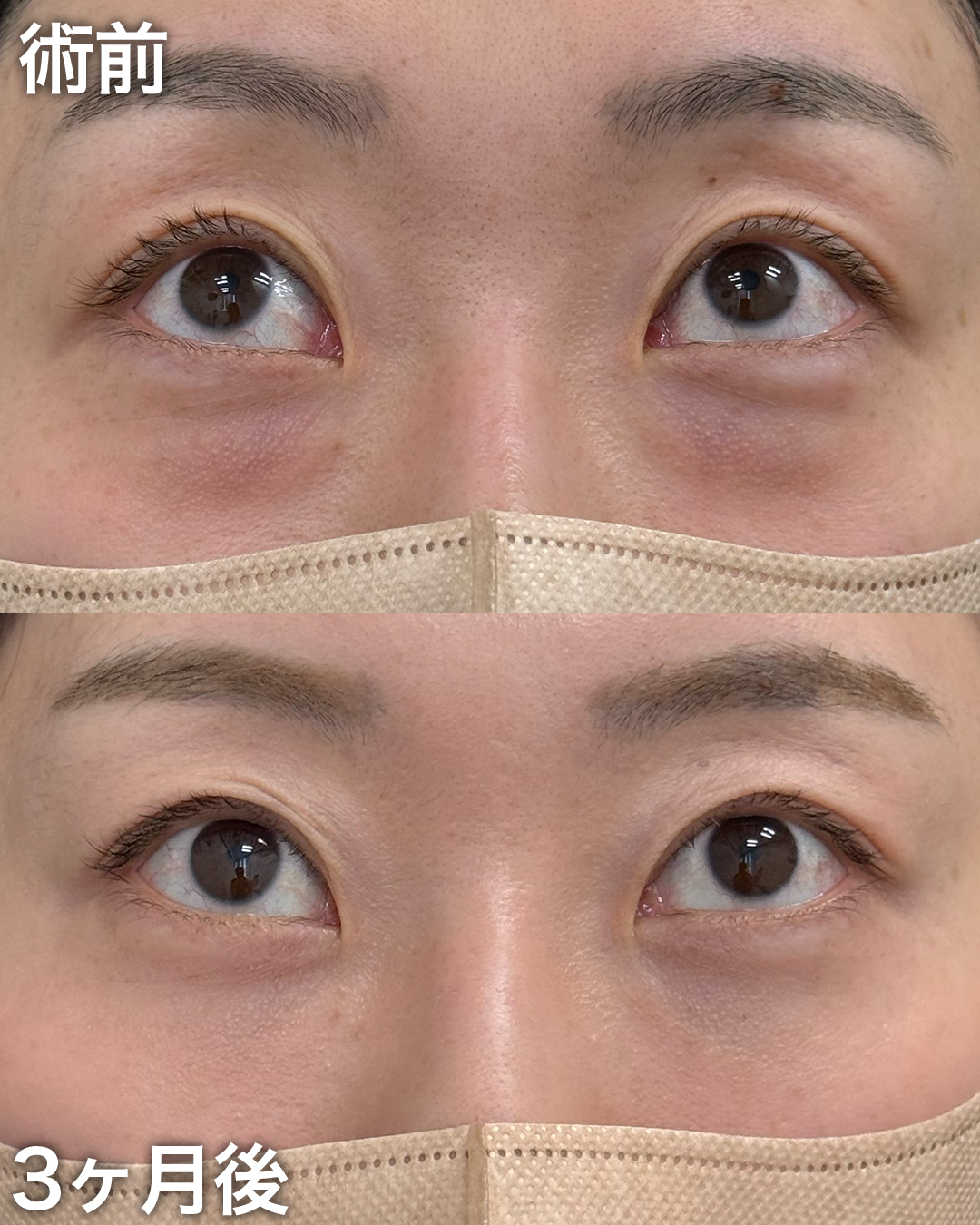 30代の方：裏ハムラ