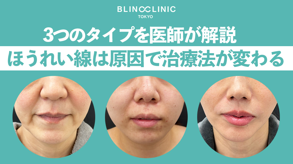 ほうれい線は原因で治療法が変わる｜3つのタイプを医師が解説
