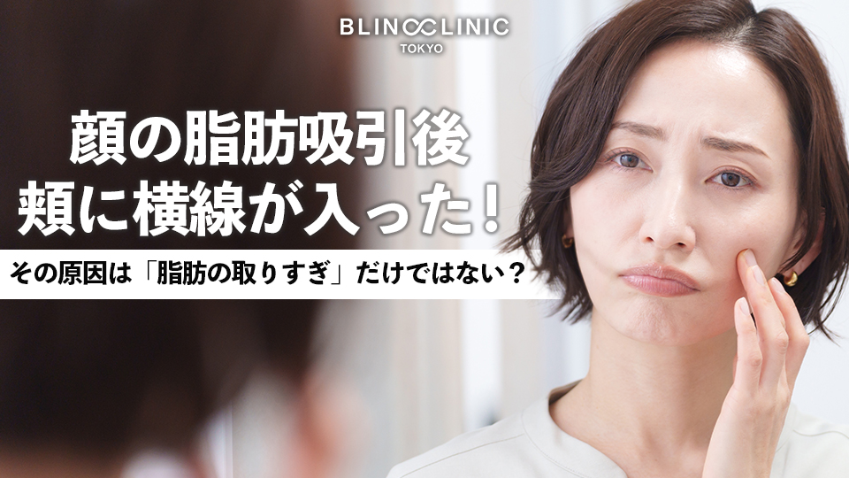 顔の脂肪吸引後、頬に横線が入った！その原因は「脂肪の取りすぎ」だけではない？【医師解説】