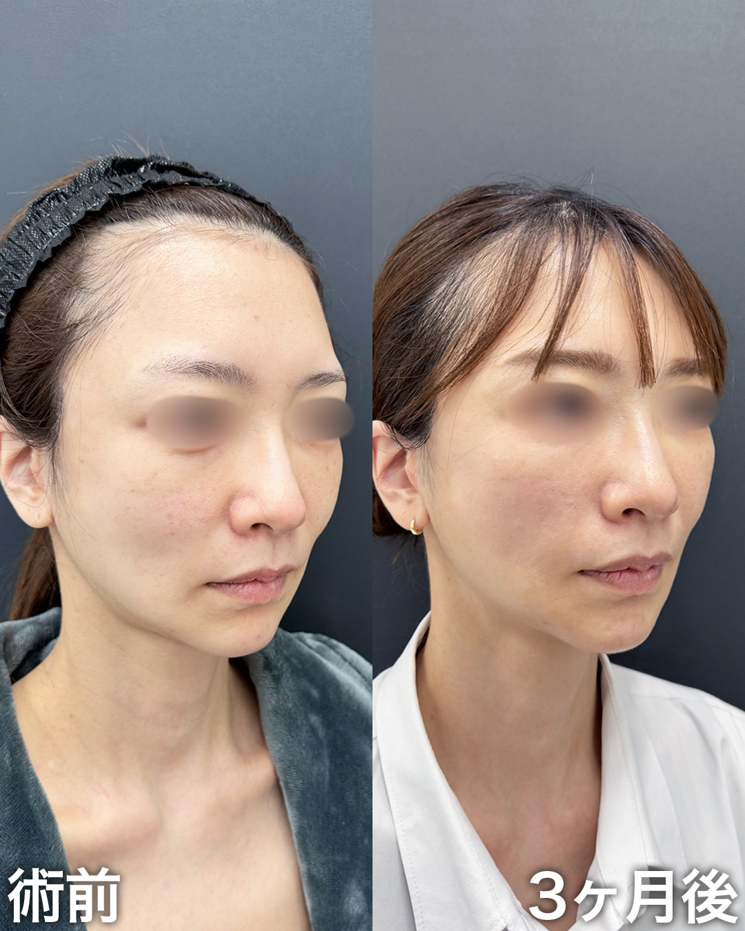 30代の方：ミッドチークバックリフト®︎・脂肪吸引(頬・ジョールファット)・糸リフト・クォンタムRF(ナゾラビアルファット・フェイスライン)