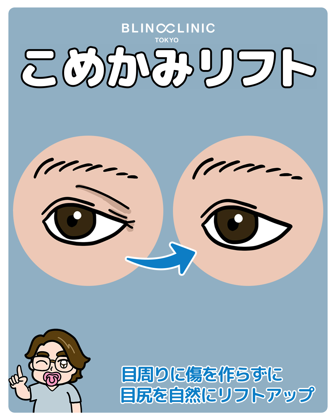 こめかみリフト