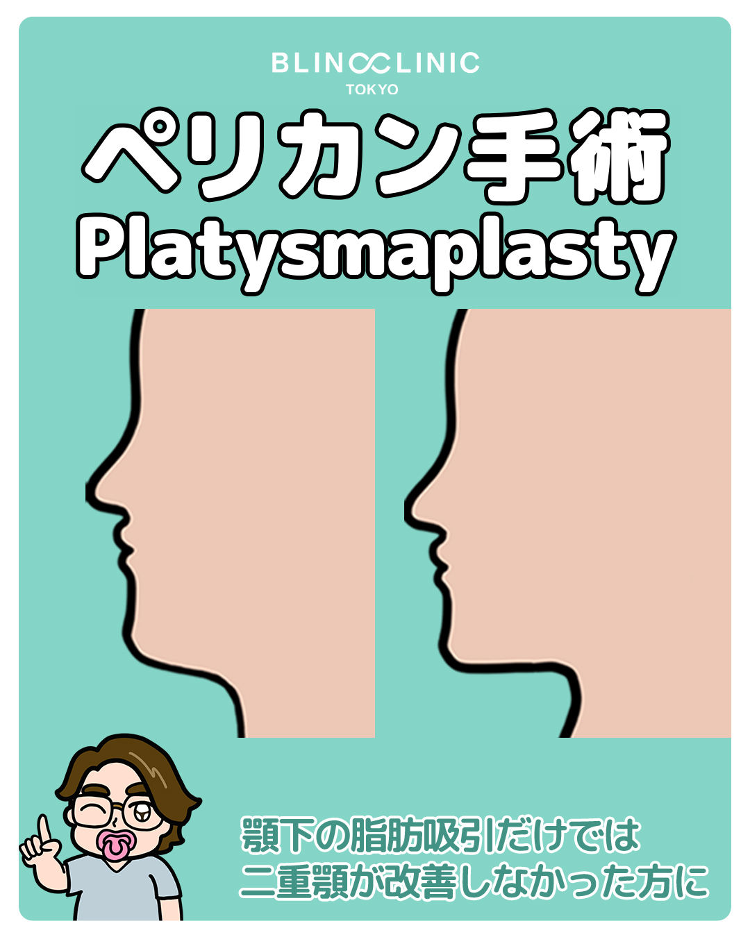 ペリカン手術(広頸筋縛り)/Platysmaplasty(ミューイングリフト)