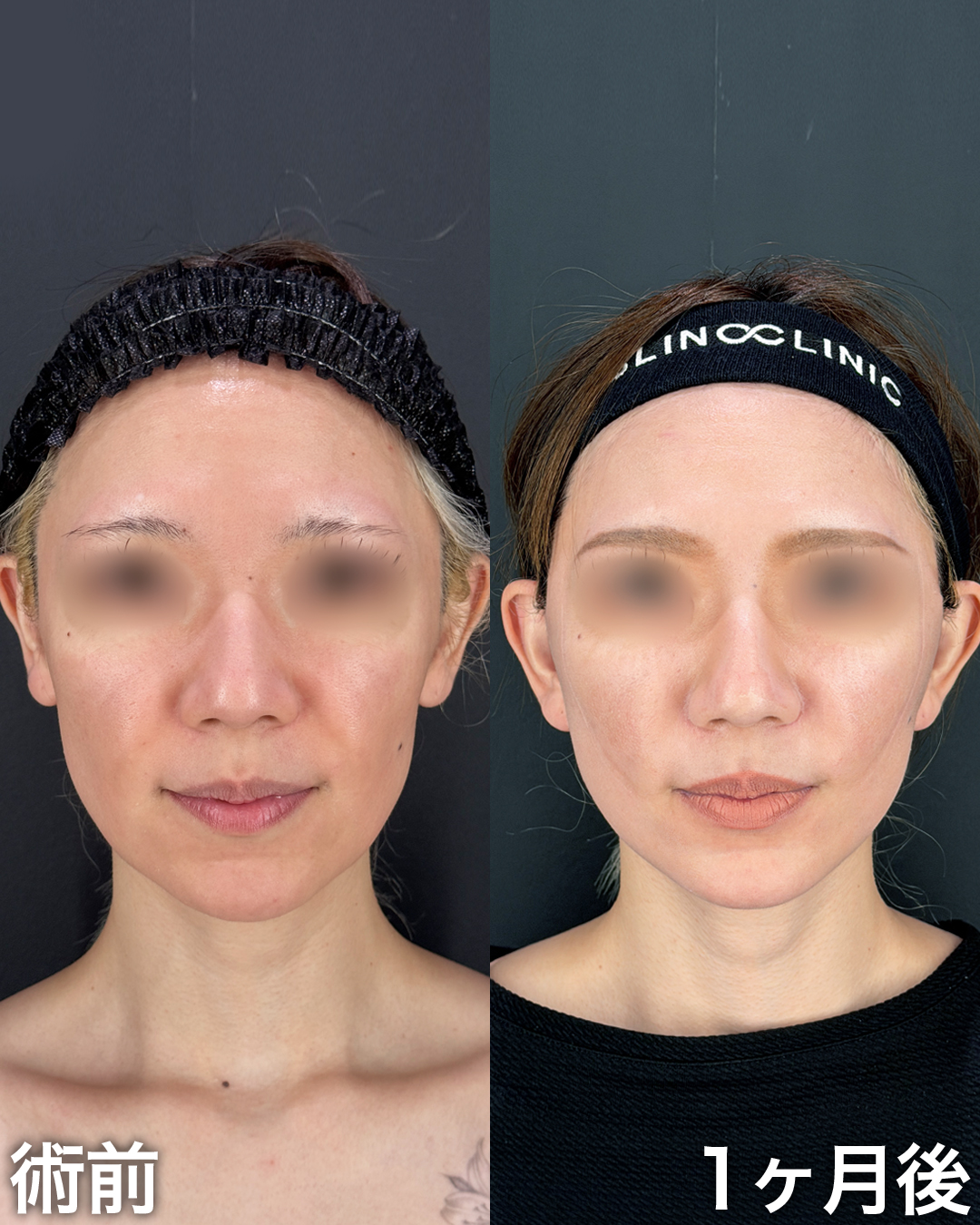 30代の方：切開リフト(Deep Plane Face Lift )・切開ネックリフト・脂肪吸引(ナゾラビアルファット)
