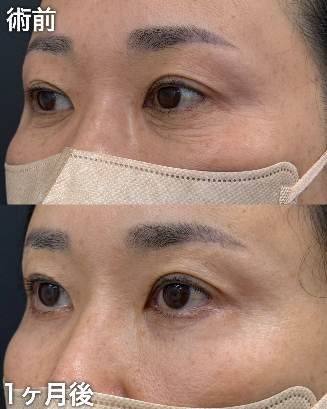 50代の方：表ハムラ