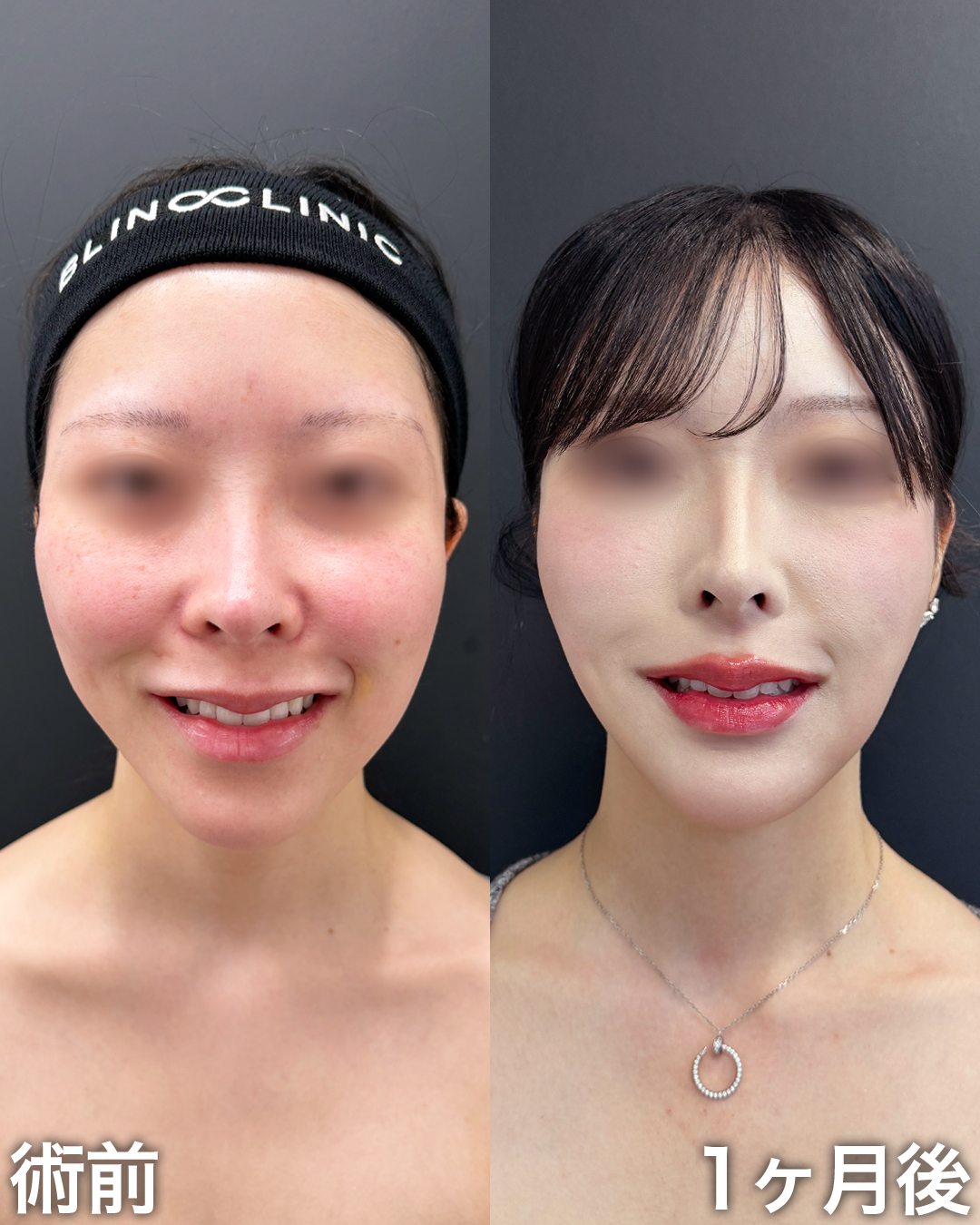 20代の方：脂肪吸引(チークボーンファット・じょーるファット・頬・顎下)・ミッドチークバックリフト®︎・バッカルファット除去・クォンタムRF(下顔面・中顔面・顎下)・糸リフト