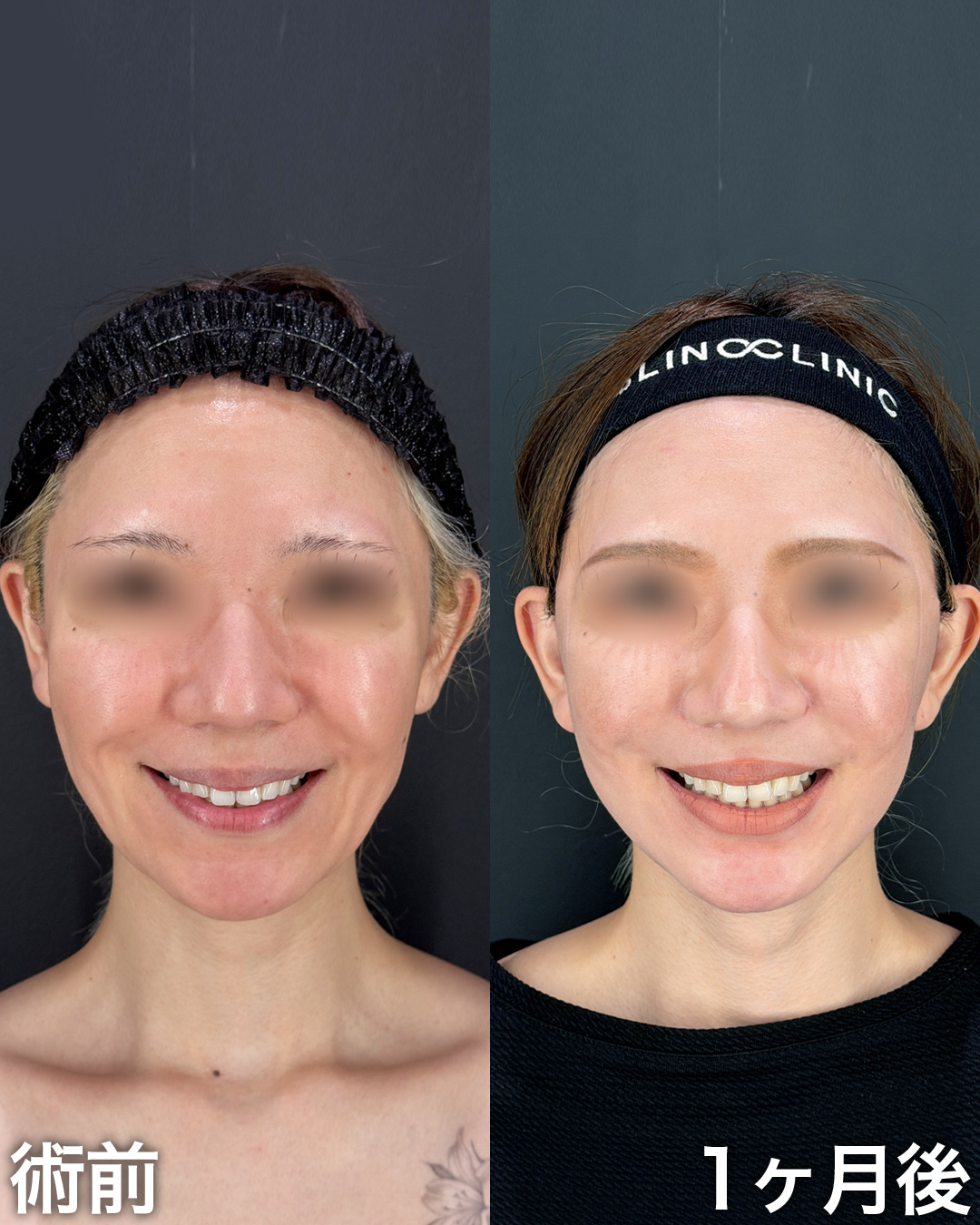 30代の方：切開リフト(Deep Plane Face Lift )・切開ネックリフト・脂肪吸引(ナゾラビアルファット)