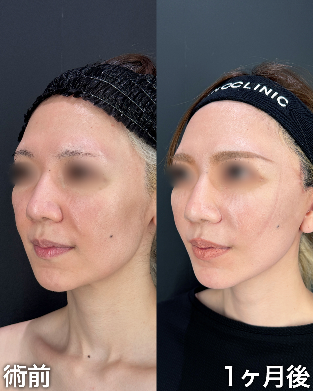 30代の方：切開リフト(Deep Plane Face Lift )・切開ネックリフト・脂肪吸引(ナゾラビアルファット)