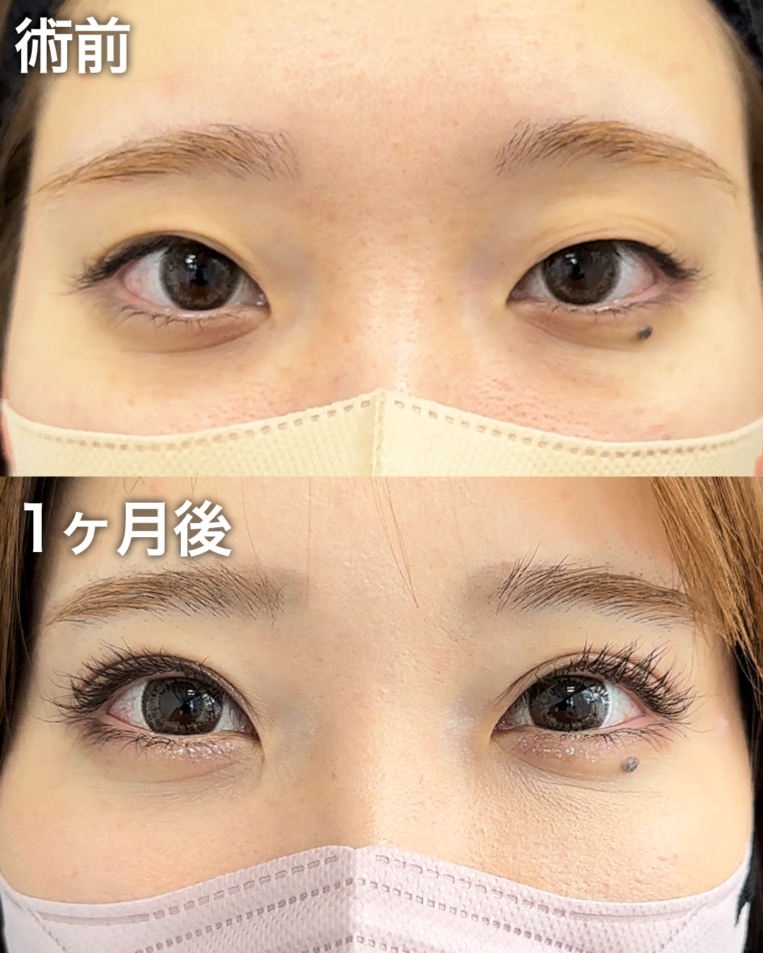 20代の方：二重埋没