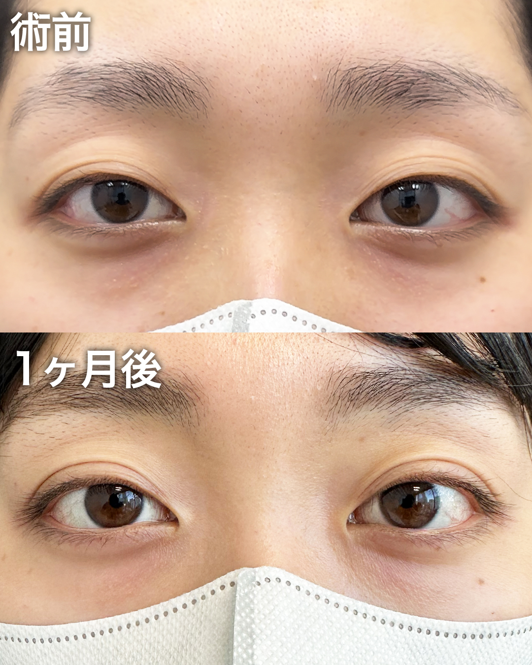 20代の方：二重埋没