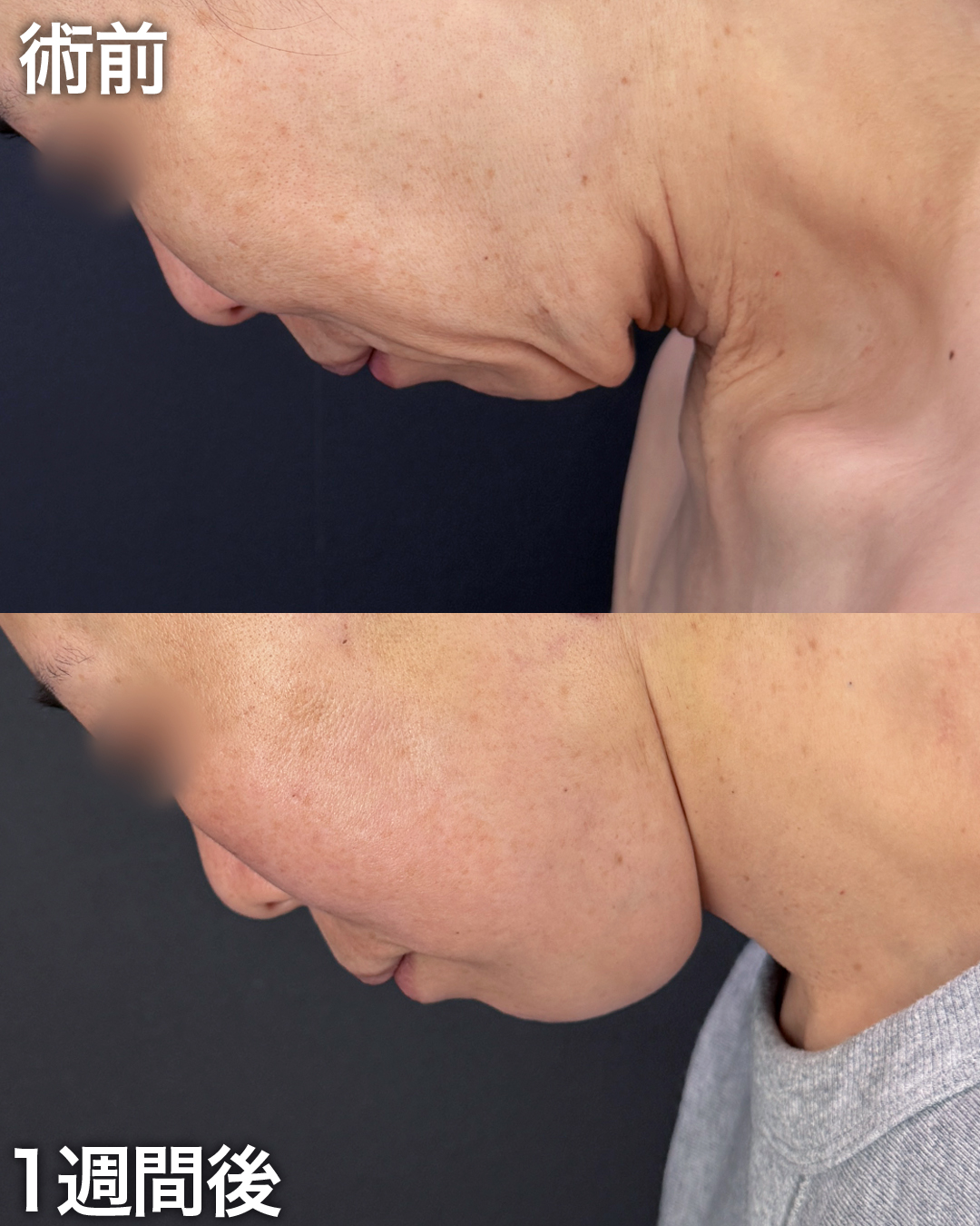 50代の方:切開リフト(Deep Plane Face Lift)・切開ネックリフト