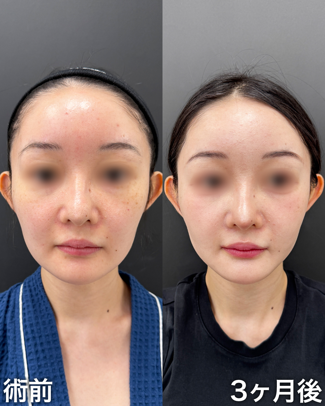 30代の方：脂肪吸引(ジョールファット)・糸リフト