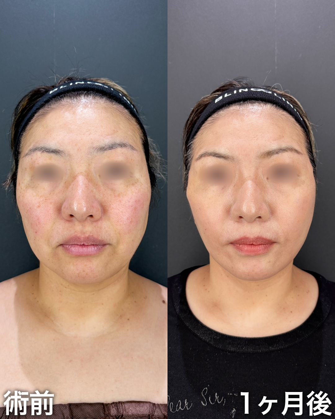 40代の方：切開リフト(Deep Plane Face Lift )・切開ネックリフト・脂肪吸引(顎下・ジョールファット)