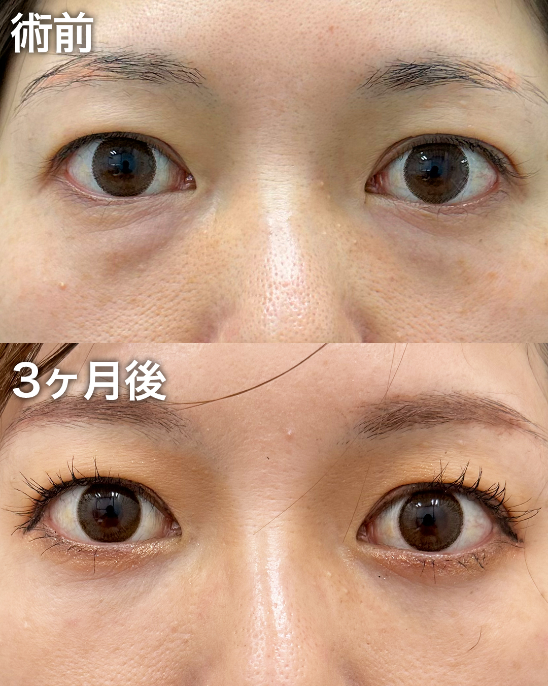 30代の方：目の下のクマ取り