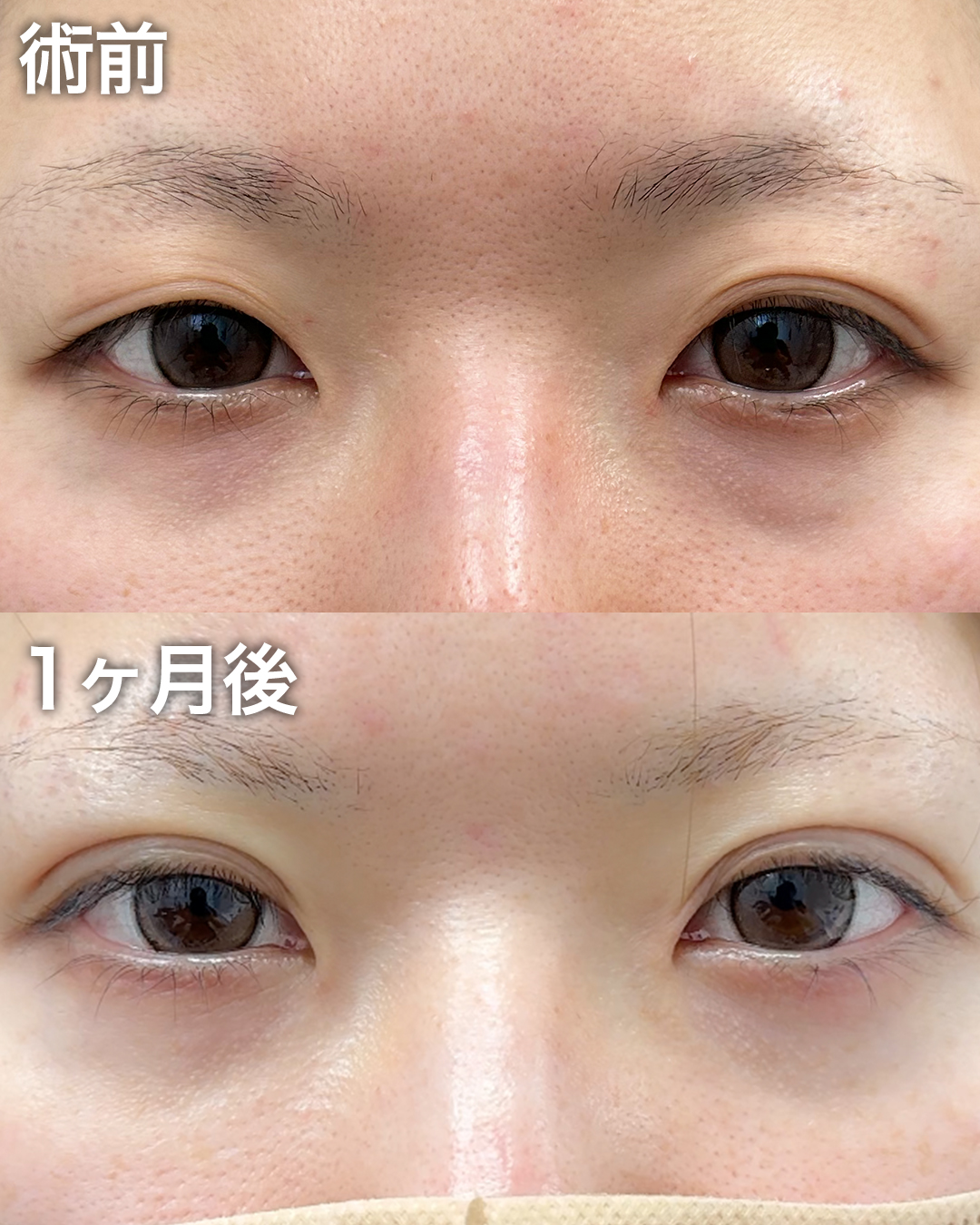 30代の方：二重埋没・まぶたの脂肪取り・目の下のクマ取り
