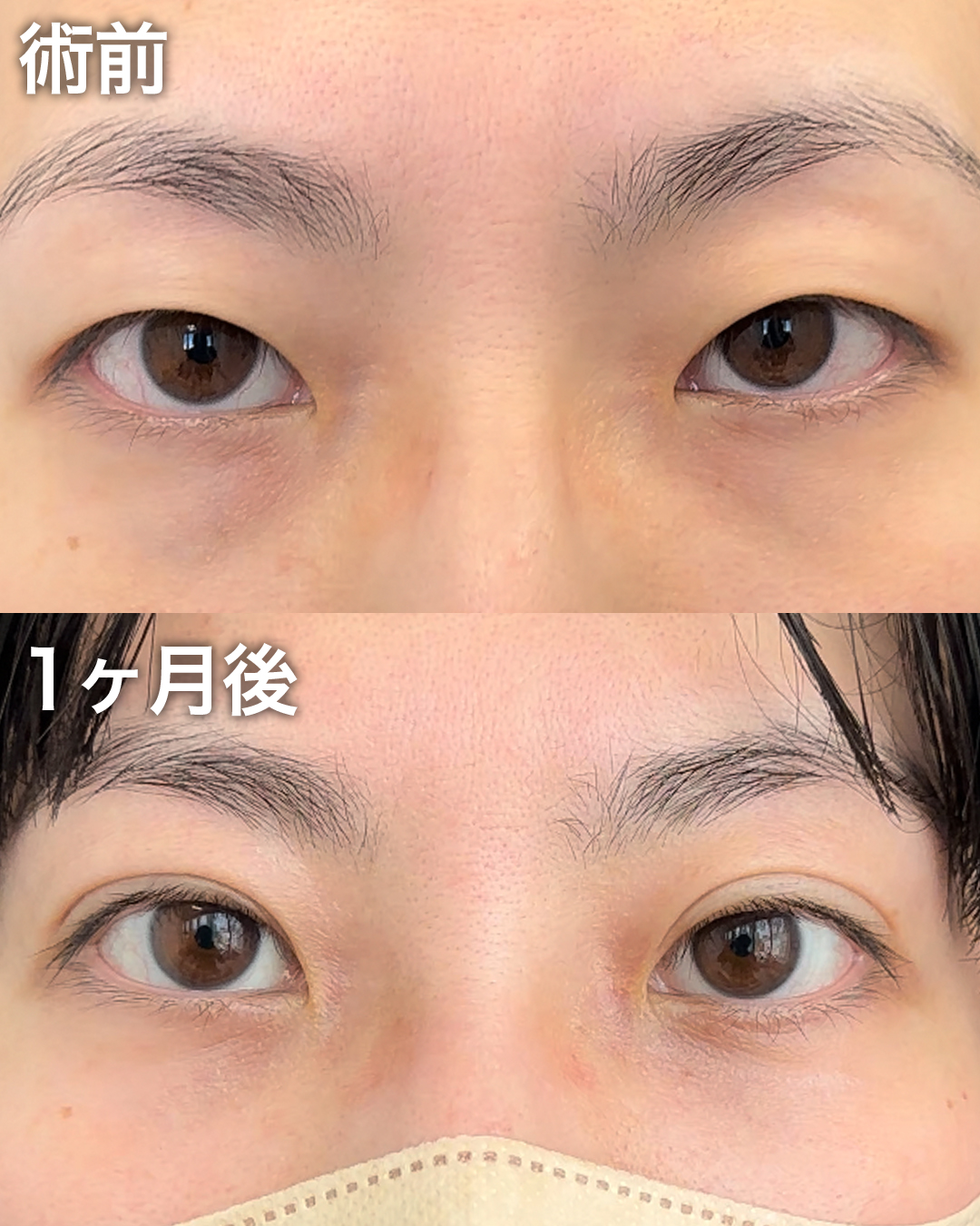 30代の方：二重埋没・まぶたの脂肪取り・目の下のクマ取り