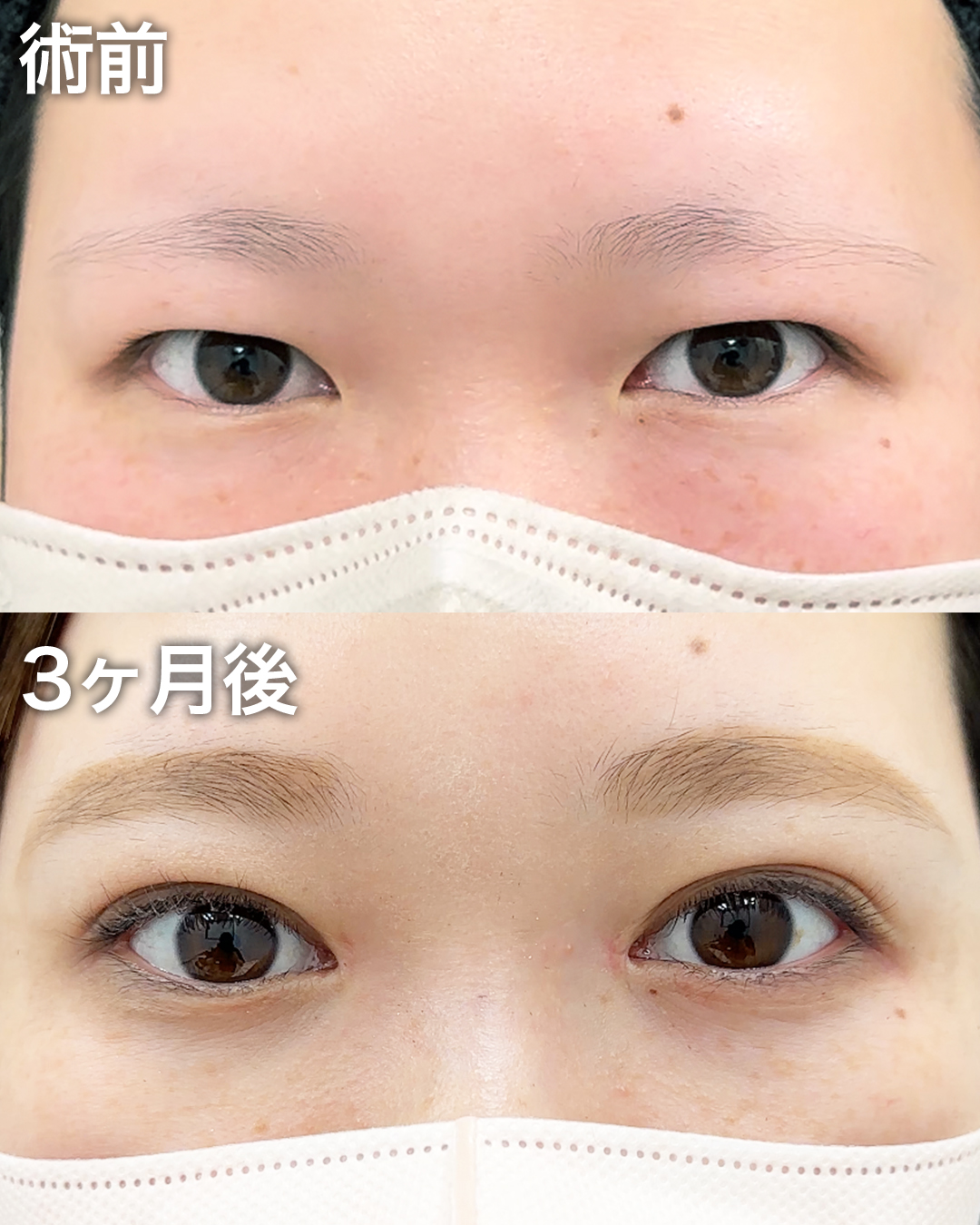 20代の方：二重埋没・まぶたの脂肪取り・目頭切開・目の下のクマ取り