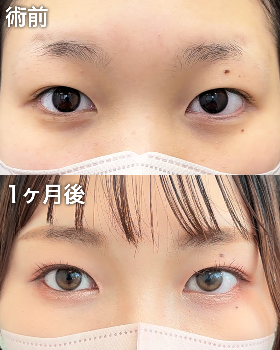 10代の方：二重埋没