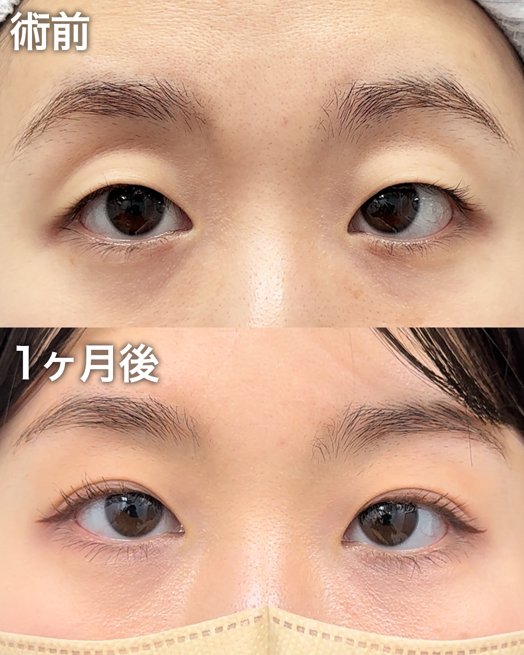 20代の方：二重埋没