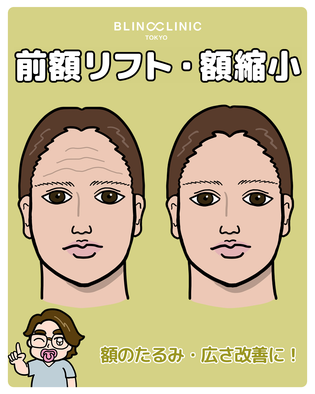 前額リフト・額縮小