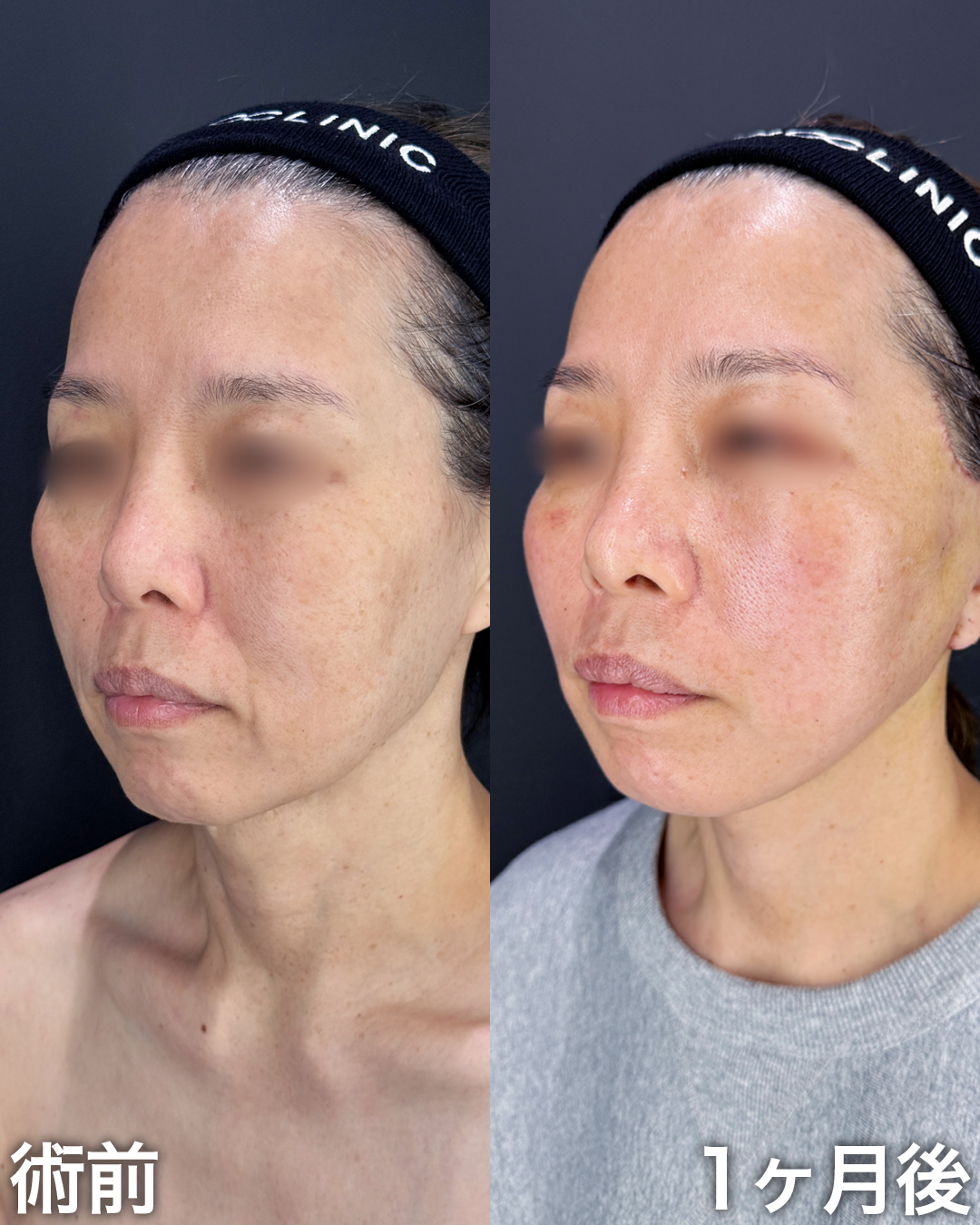 50代の方:切開リフト(Deep Plane Face Lift)・切開ネックリフト
