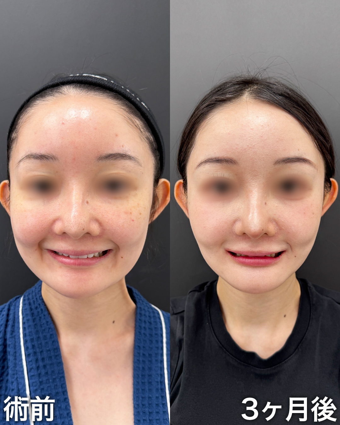 30代の方：脂肪吸引(ジョールファット)・糸リフト